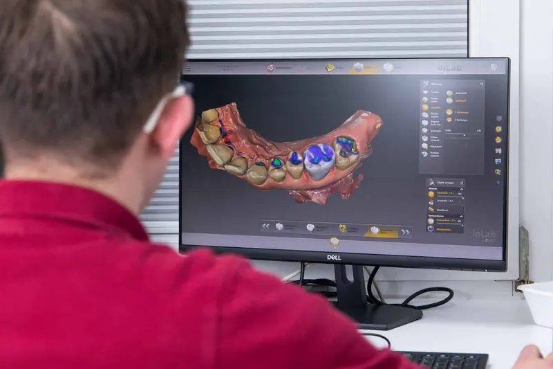 Digitale Planung von Kronen am Bildschirm